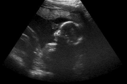 Ultrasounds Of Boys. ultrasound-baby-dunn